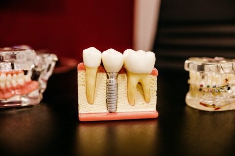 Extracția dentară: avem sau nu nevoie de un implant dentar?