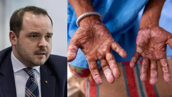 Alertă de gradul zero! Caz de lepră în România! Femeie care lucrează la un SPA din Cluj, confirmată cu lepră